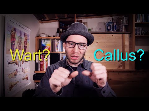 How to Tell If You Have a Callus or a Plantar Wart - Plantar Wart Remedy That Works