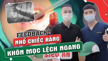 TRẢI NGHIỆM THỰC TẾ NHỔ RĂNG KHÔN 90 ĐỘ | Nhổ răng tại Nha khoa Italiano |