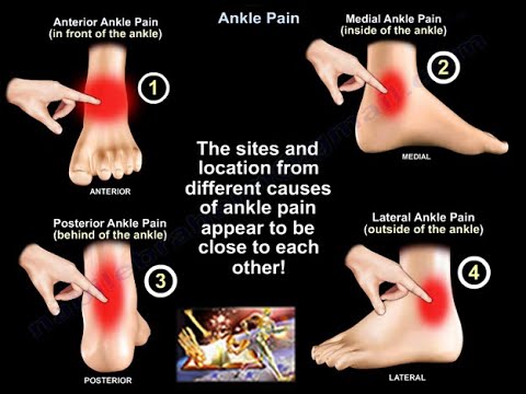 Download Ankle Pain - Everything You Need To Know - Dr. Nabil Ebraheim