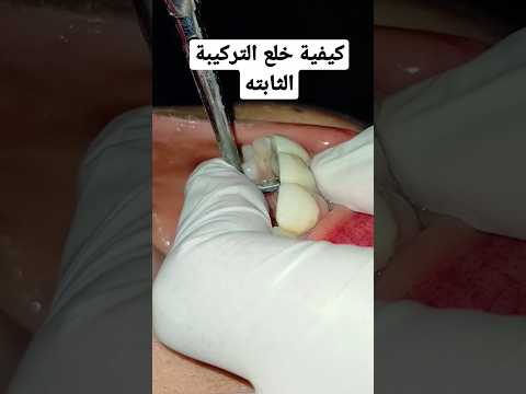 كيفية خلع التركيبة الثابتة Dentistry Crown Remover Crown Removal Removal Crown
