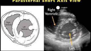 Cardiac Ultrasound - Parasternal Short Axis - Sonosite Inc