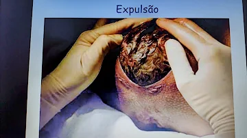 Quanto tempo leva para sair a placenta?