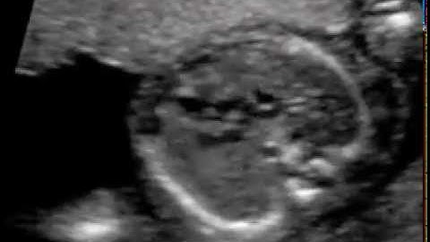 Interrupted IVC with azygous vein