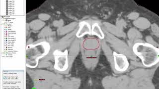 Contouring Prostate   Prostate Only