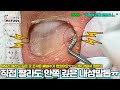 아무리 직접 짜르려 해도 깊은 곳 발톱조각은 빼낼수 없었던 내성발톱!!! #레푸스 #refuss #내성발톱 #무좀발톱 #발톱 #toenails #ingrown_toenail