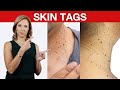 1 Thing Your Doctor NEVER Told You About Skin Tag | Dr. Janine