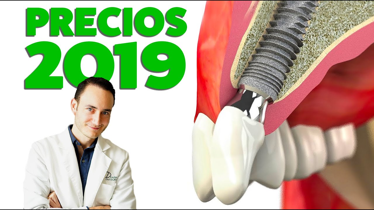 Sembrar Indígena semiconductor Implantes Dentales PRECIOS 2019 ¿Subirán de precio este año? - YouTube