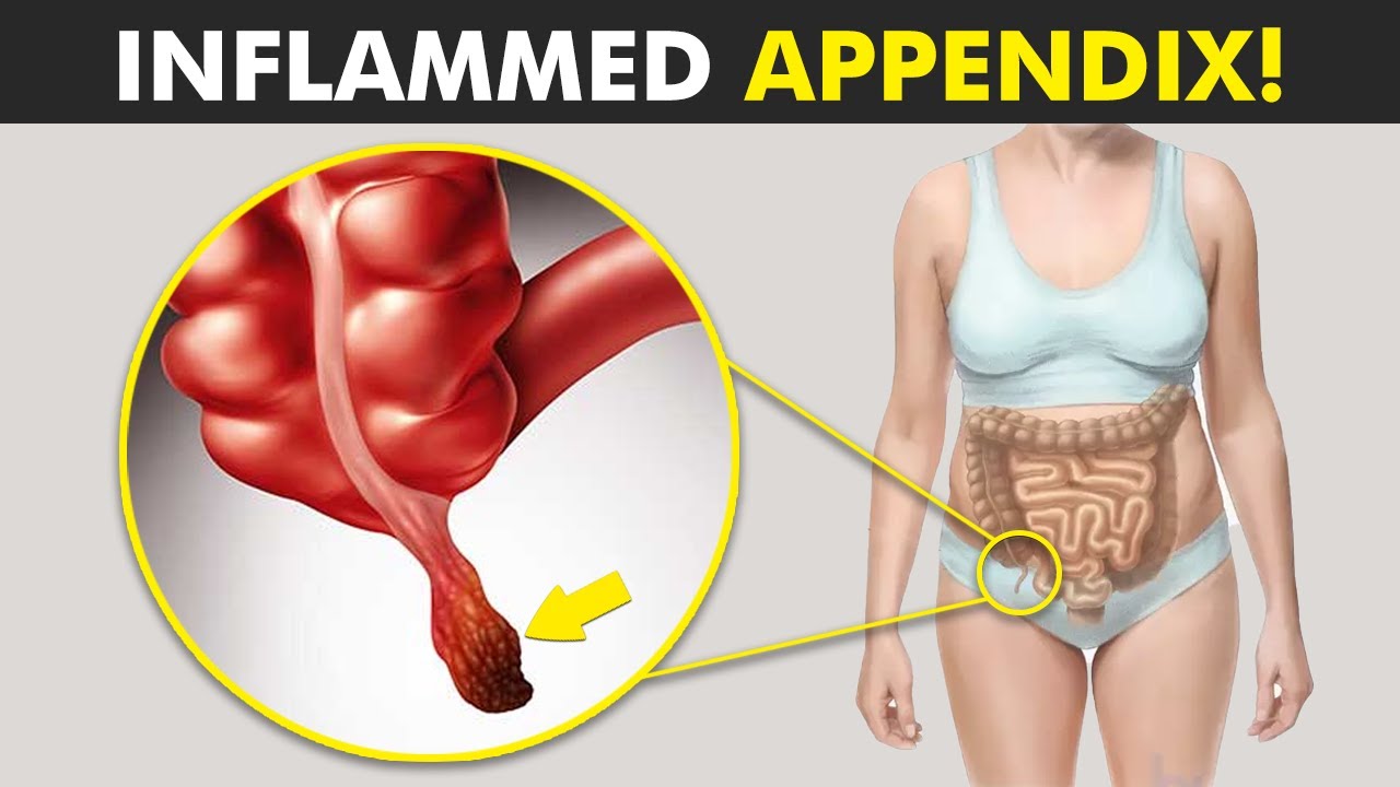 How Appendix Inflamed In Human Body? (Appendicitis) YouTube