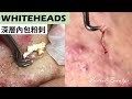 深層內包粉刺(deep whiteheads) - Taiwan Tainan台南清粉刺最乾淨
