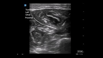 Wrist Ultrasound: Ulnar Nerve Block