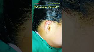 Bat Ear Correction Surgery | निकले हुए कानों का स्थायी इलाज | Otoplasty Surgery Result | India