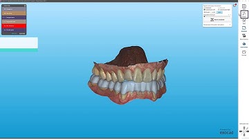 How to design bite splints with the iTero™ Design Suite | Digital workflow tutorial