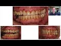Upper Anterior Teeth Restored