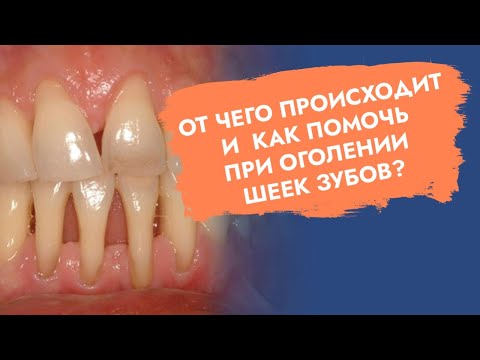 Оголяются корни зубов. Рецессия десны.