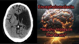 Encephalomalacia "Mushy Holes in the Brain" from Traumatic Brain Injury