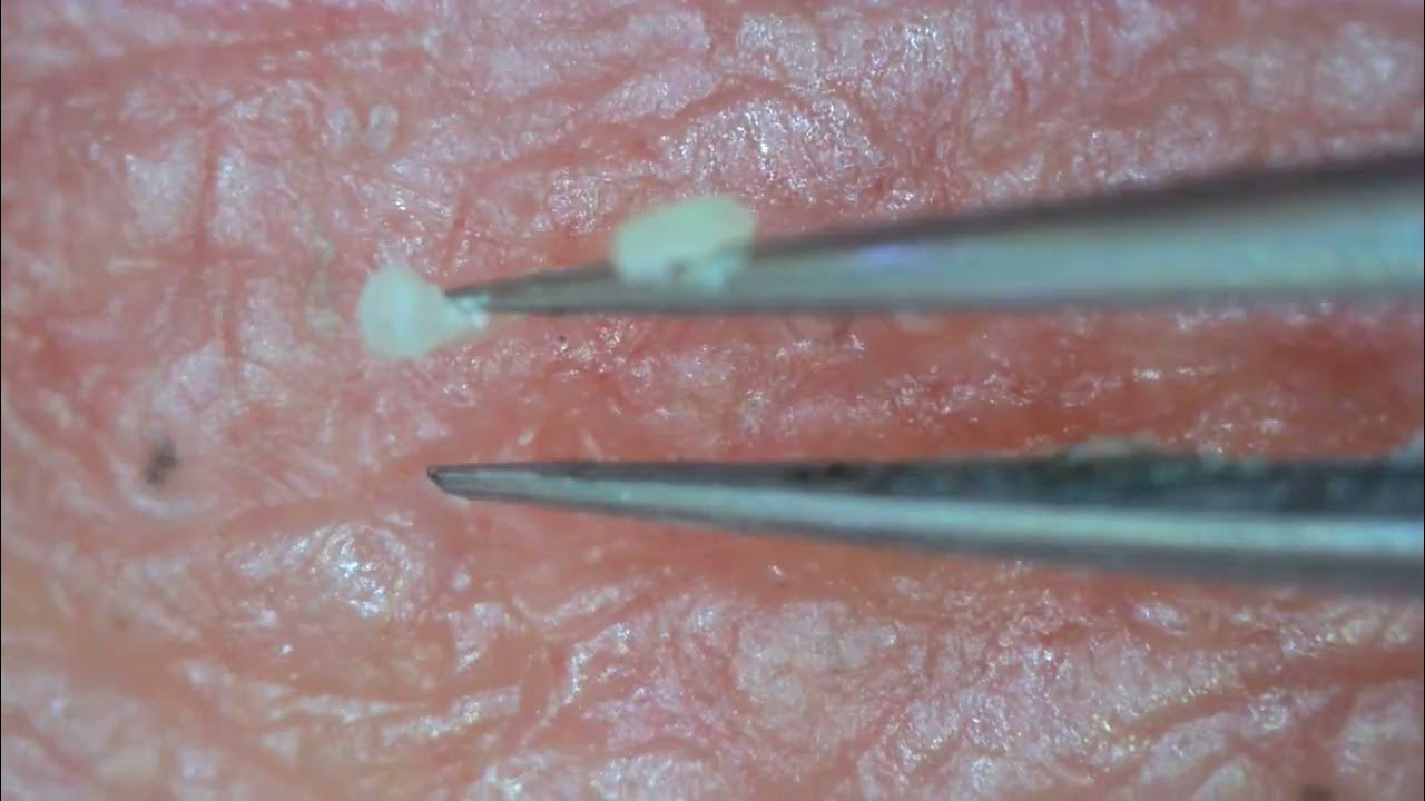 0219 keratin plug removal chin YouTube
