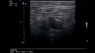 DVT Ultrasound