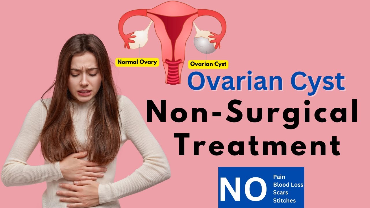 Ovarian Cyst NonSurgical Treatment without any pain cutting bloodloss