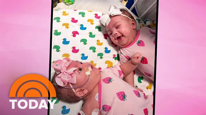 Separated conjoined twins heading home after successful surgery - DayDayNews