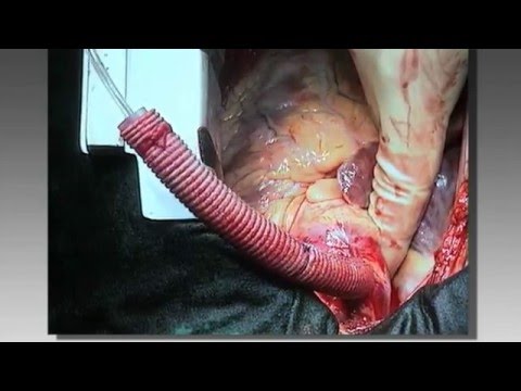 Video: Pembedahan Jantung Terbuka: Risiko, Prosedur, Dan Persiapan