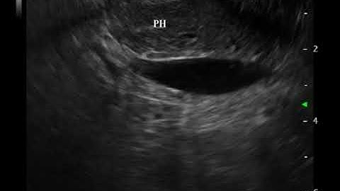 Video 19 Scanning Ampulla and Papilla from Duodenum