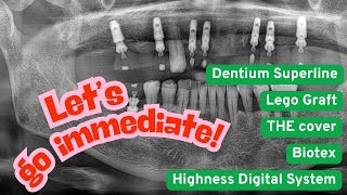 Immediate implant &amp; restoration using Highness (ft. Lego graft, THE cover, biotex)