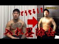 入れ墨除去してみた《official》