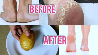 Eliminate Cracked Heels and get White and Smooth Feet \/ Magic Cracked Heels home remedy