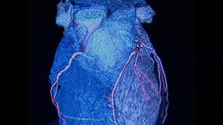 New guidelines on caring for patents at risk of heart disease- What you need to know
