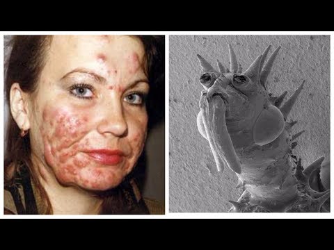 Видео: Муур дахь демодектик өвчнийг эмчлэх - Муур дахь Demodex хачиг