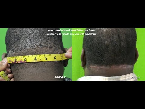 bumps back of neck, razor bumps back of head, Acne Keloidalis Nuchae removal changes patient&#;s life