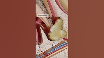 How does a Chronic Apical Abscess develop? A 3D visualization with VOKA
