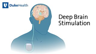 Deep Brain Stimulation (DBS) for Epilepsy | Duke Health