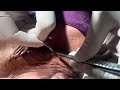 How to Remove Stitches/ टाँके कैसे काटे / टाँके काटने का सही ✅ तरीक़ा/#stitches #remove #doctor #gnm