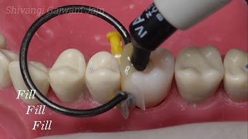 Injection molding Basics: Class II cavity simplified