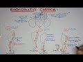 Radiculitis Ciática L4 L5 S1 - Hernia de disco lumbar