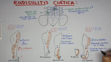 ¿Es ciática la L5-S1?