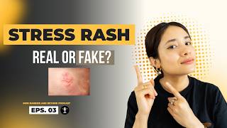 Can Stress Cause a Rash? Stress Rash Explained | Podcast Eps 03