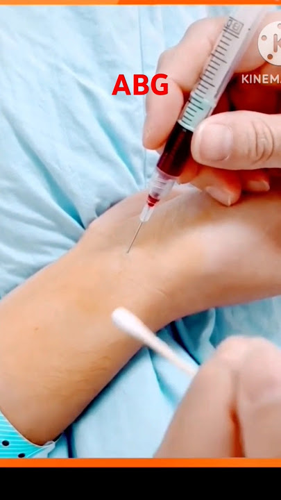 ABG (arterial blood gas) collection  # youtu.be/bv_JcUNZ5aA