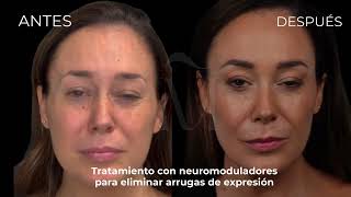 Tratamiento De Arrugas Con Neuromoduladores Antes Después Medicina Estética Málaga