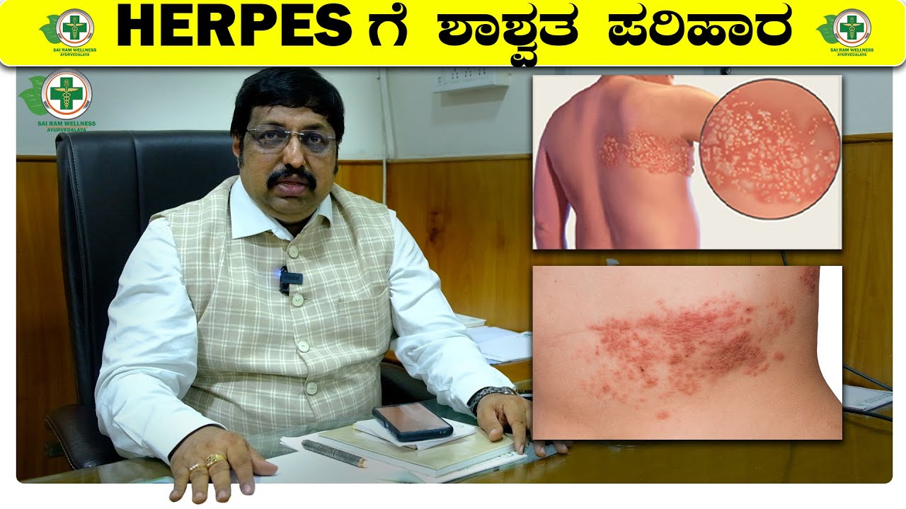 herpes ಗೆ ಶಾಶ್ವತ ಪರಿಹಾರ herpes ayurvedic in kannada Dr vivekananda