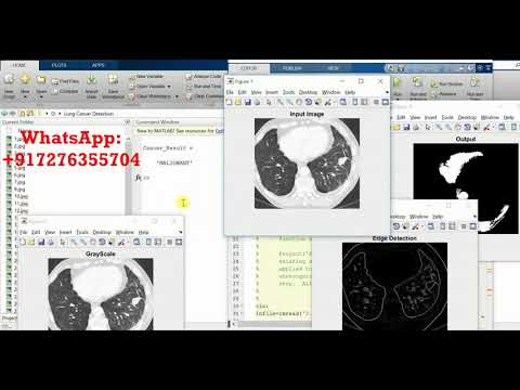 Lung Cancer Detection Using Matlab Source Code FINAL YEAR PROJECT