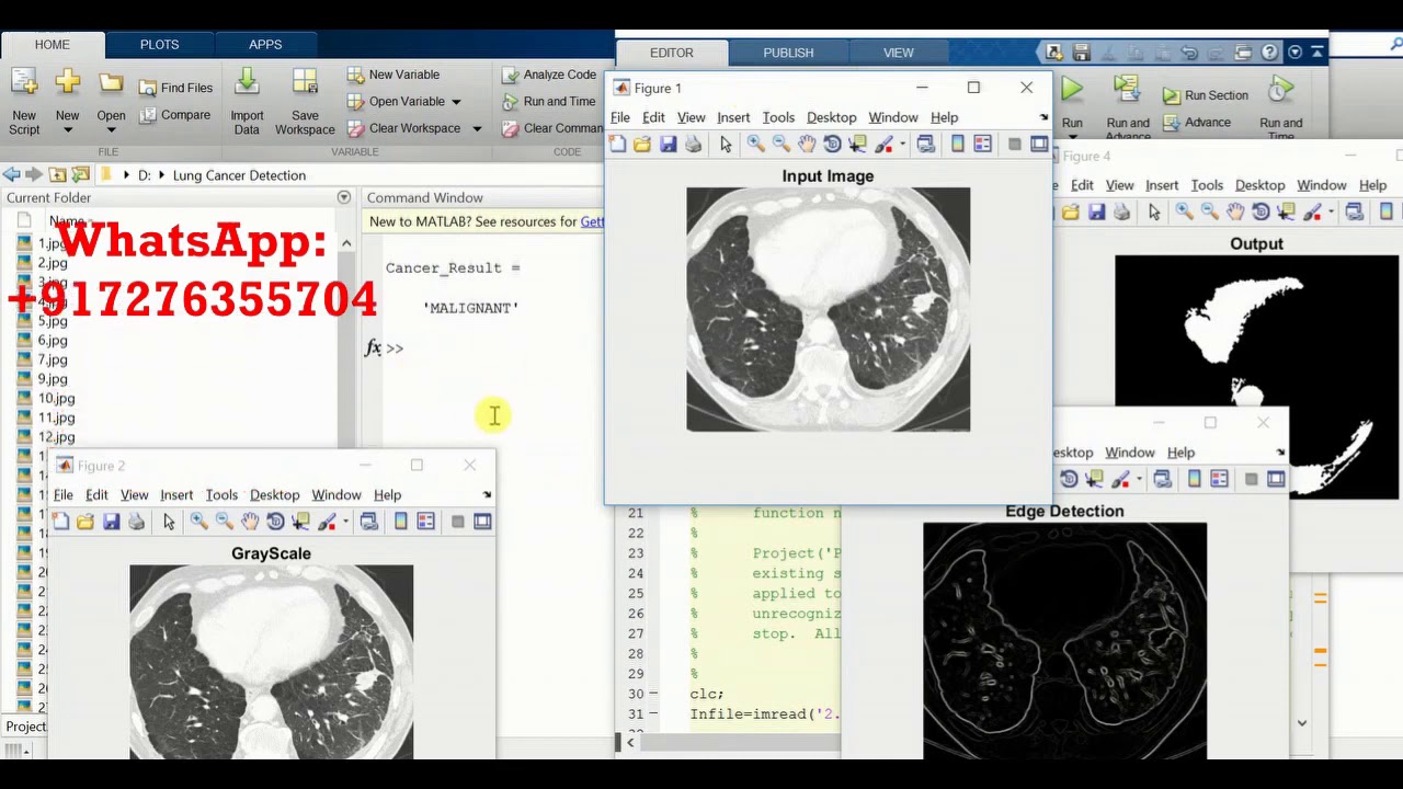 Lung Cancer Detection Using Matlab Source Code FINAL YEAR PROJECT - YouTube
