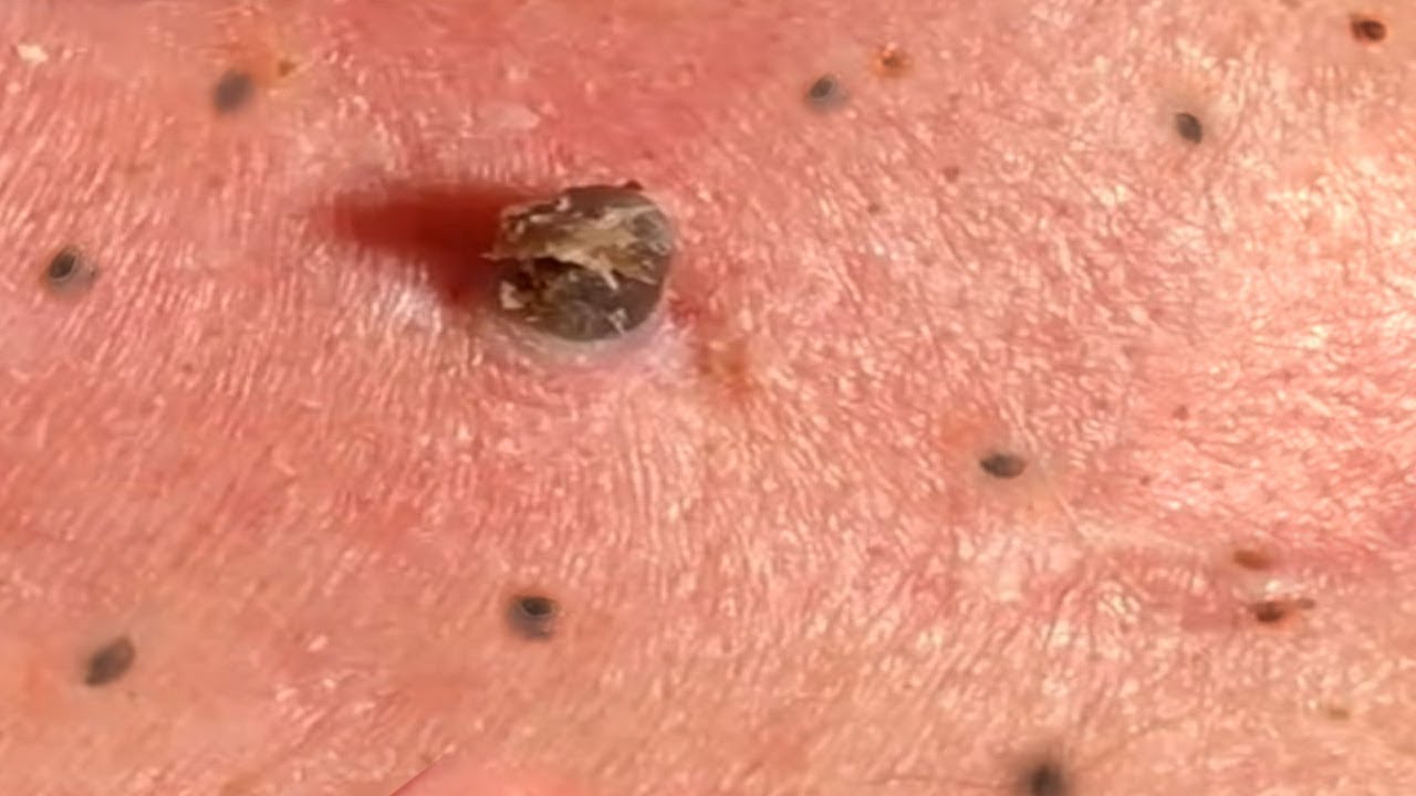 How To Get Rid Of A Large Blackhead On My Back HOWOTRE