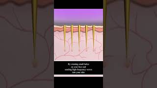 Secret Rf L The Heal Clinic