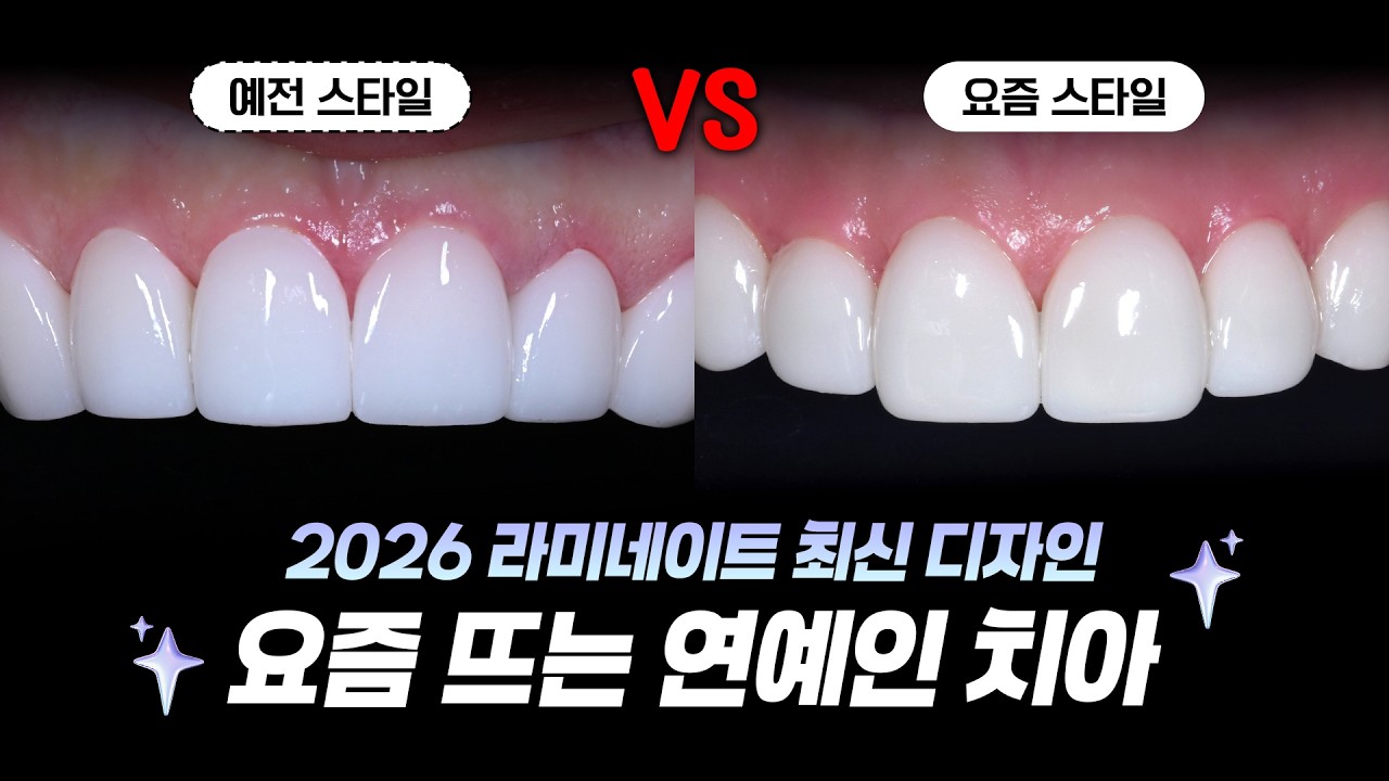 2026 라미네이트 트렌드✨ | 왜 요즘 연예인들은 일자 치아를 안 할까?