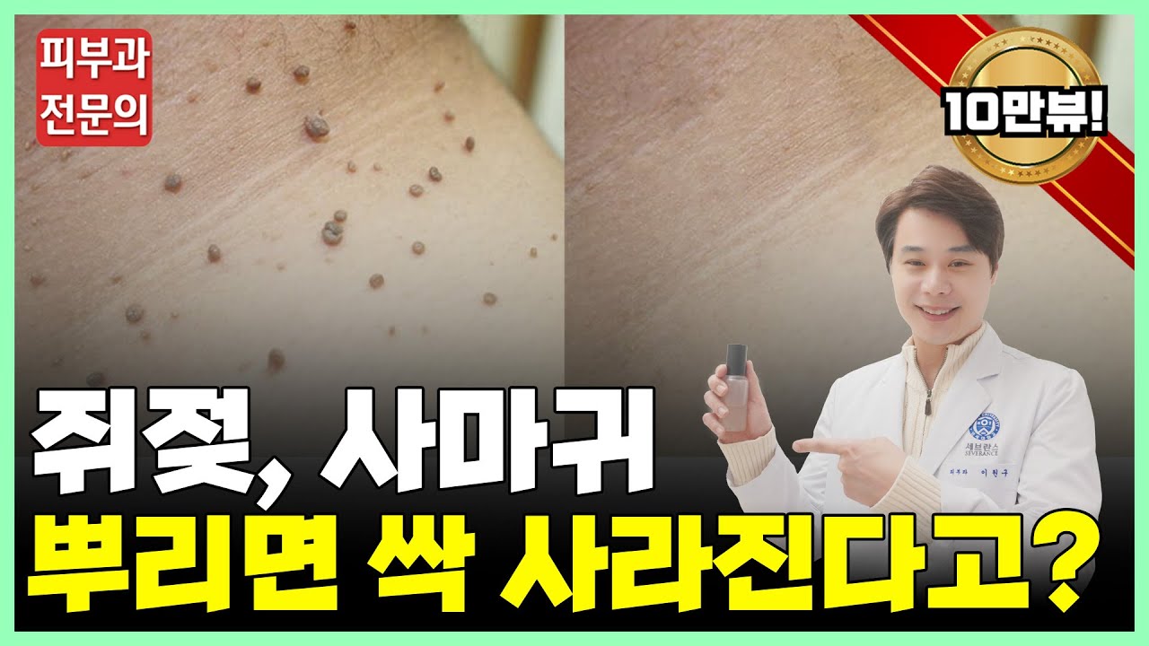 이것만 뿌리면 쥐젖, 사마귀 전부 쉽게 제거? 피부과전문의가 알려주는 쥐젖, 편평사마귀 없애는 법 | 부산피부과 - YouTube