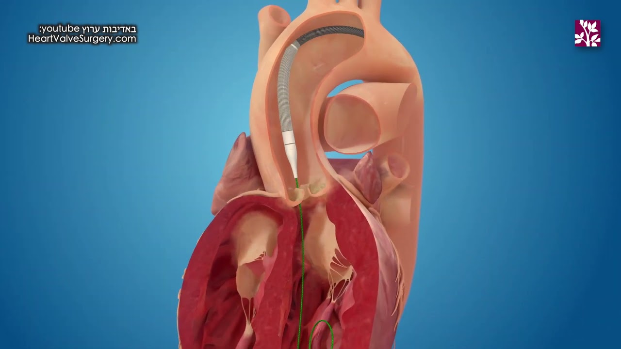 שיא חדש: מטופל בן 97 עבר לאחרונה בהצלחה החלפת מסתם בליבו