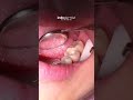 PROSES TAMBAL SEMENTARA SAAT PERAWATAN SALURAN AKAR  #dentalclinic #dentistry #edukasigigi