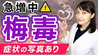 梅毒が急増中！見た目でわかる性感染症について徹底解説